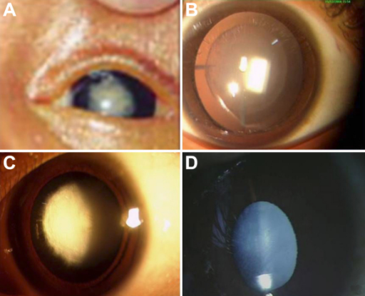 선천백내장의 다양한 유형. (A) 핵백내장, (B) 층판백내장, (C) 전극백내장, (D) 전체백내장.