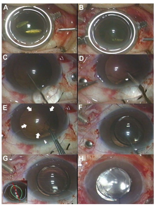 Intraoperative photographs showing pars plana lensectomy for dropped nucleus removal from vitreous cavity