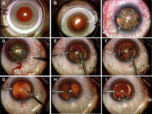 Femtosecond laser-assisted cataract surgery with the LDV Z8 system showing suction ring application and capsulotomy