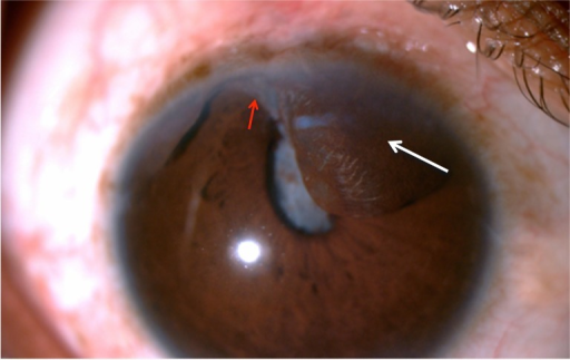 Slit lamp photograph showing anterior segment findings after cataract extraction