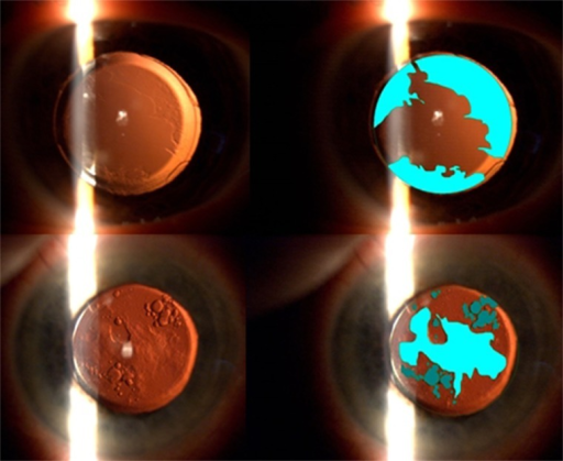 후낭혼탁의 역조명(retroillumination) 세극등 사진 및 EPCO2000 소프트웨어 분석. 후낭의 혼탁 범위와 밀도를 정량적으로 평가.