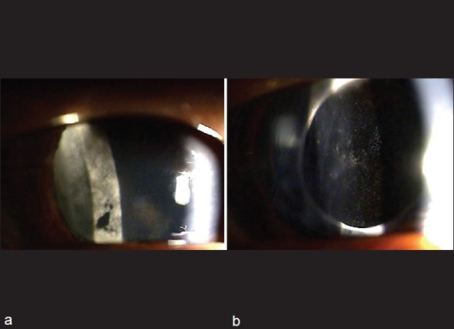 (a) Slit lamp biomicroscopic image of the right eye on postoperative day 11 showing white blood cells in <b>anterior</b>