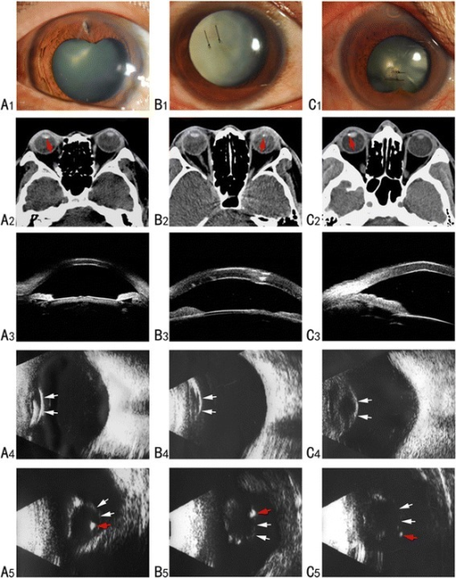Preoperative photographs of three traumatic cataract patients showing slit-lamp, CT, and B-scan ultrasound findings