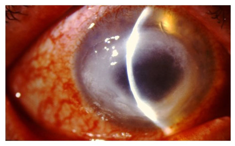 Ring infiltrate in Acanthamoeba keratitis