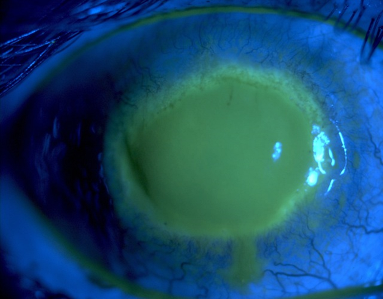 Ring infiltrate in Acanthamoeba keratitis