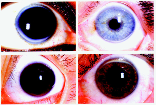 <b>Corneal arcus</b>. Four representative slides of <b>corneal arcus</b>. <b>Arcus</b> <b>deposits</b> tend to start at 
