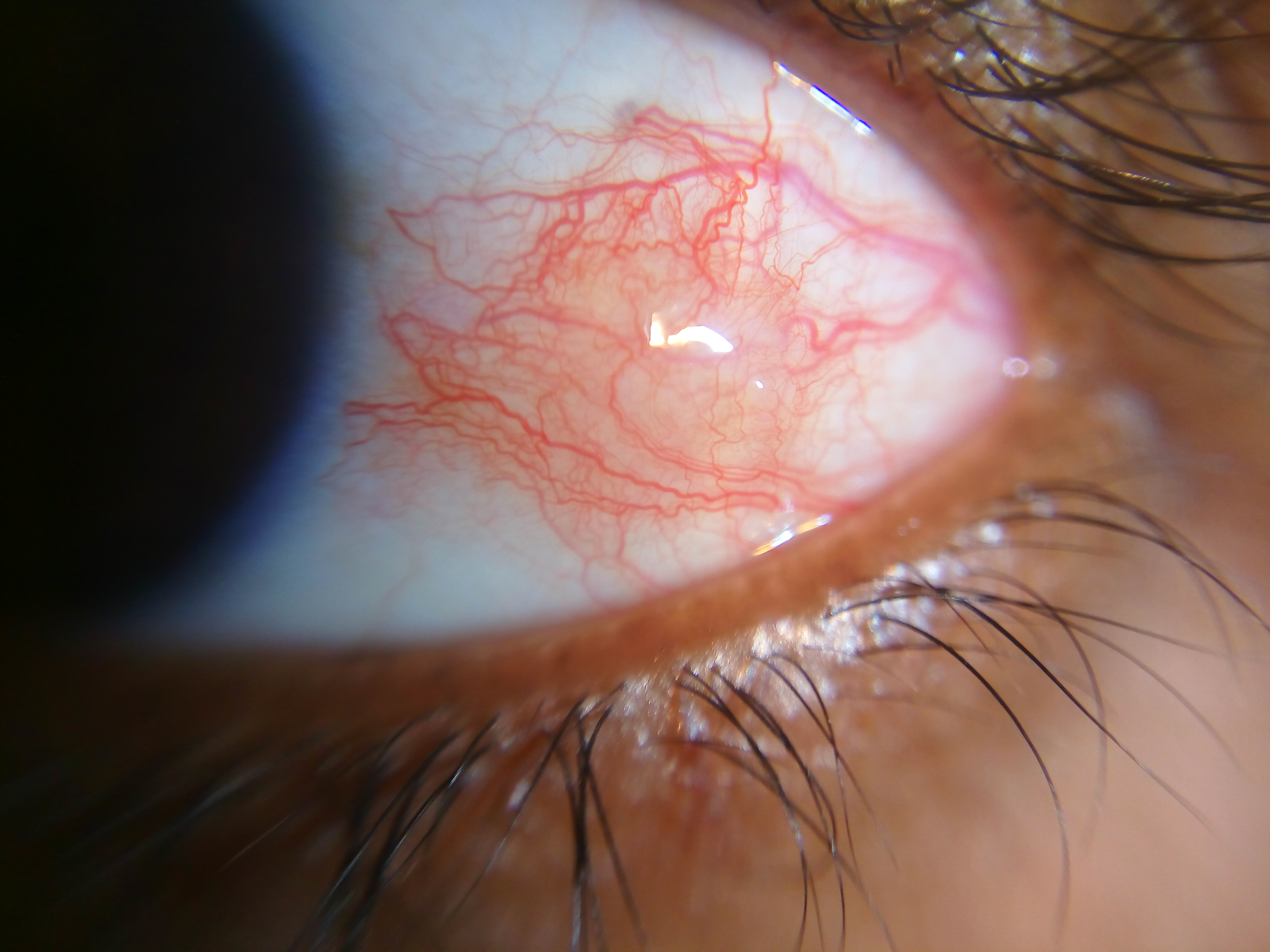 Sectoral episcleritis with redness