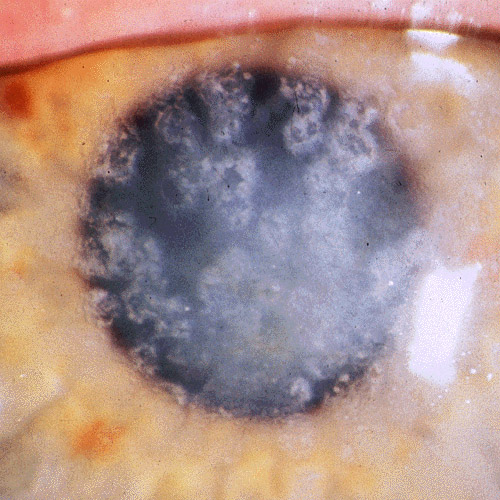 Granular corneal dystrophy type I showing crumb-like opacities