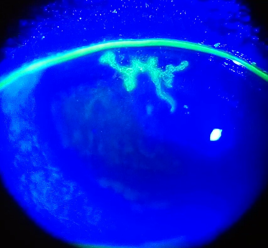 Dendritic corneal ulcer in herpes simplex keratitis