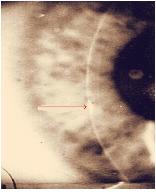 Slit lamp examination of the eye showed <b>interstitial keratitis</b>.