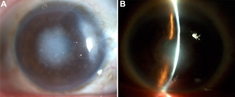 Slit-lamp examination showed an irregular <b>corneal</b> surface and several discrete, gray-white opacities in the subep