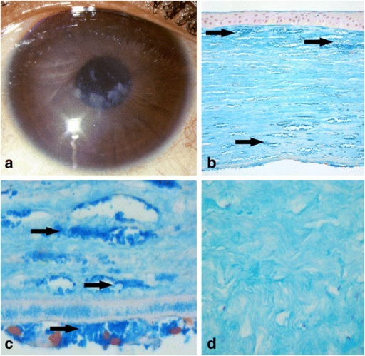 Clinical phenotypes. a. Pre-operative photograph of the right eye of IV.3 demonstrating ill-defined <b>corneal</b> strom