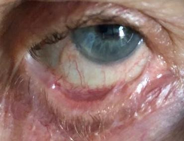 Symblepharon in ocular cicatricial pemphigoid