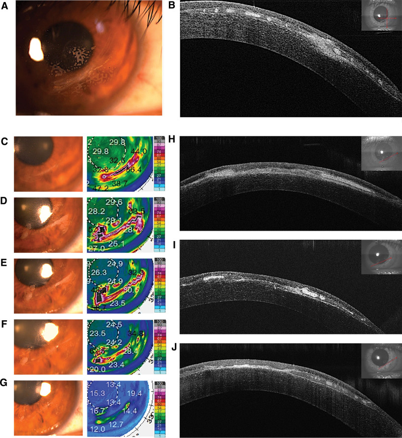 Epithelial ingrowth after LASIK