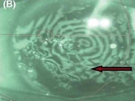 Pre- and postoperative clinical photographs of operated <b>eyes</b> with climatic droplet keratopathy. (B) Preoperative 