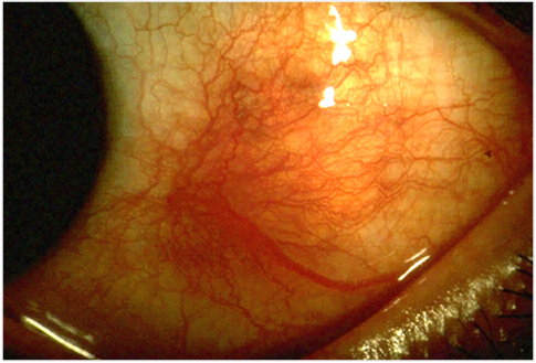 Scleritis with deep scleral inflammation