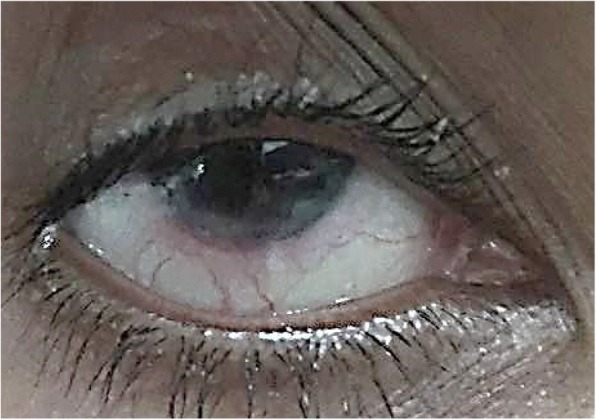 Scleromalacia perforans with uveal show