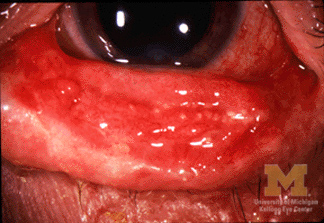 Stevens-Johnson syndrome conjunctivitis