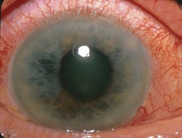 Acute angle-closure glaucoma with mid-dilated pupil