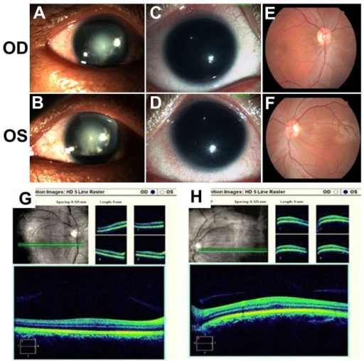 Clinical photographs of aniridia showing absent iris with PAX6 mutation