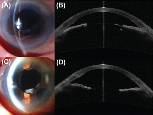 Malignant glaucoma cases showing slit lamp photographs with shallow anterior chamber and corresponding AS-OCT images demonstrating lens-iris diaphragm anterior displacement
