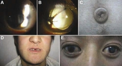 Axenfeld-Rieger syndrome clinical features: slit lamp photographs showing iris abnormalities with corectopia and polycoria, periumbilical skin redundancy, facial features with maxillary hypoplasia, and dental anomalies