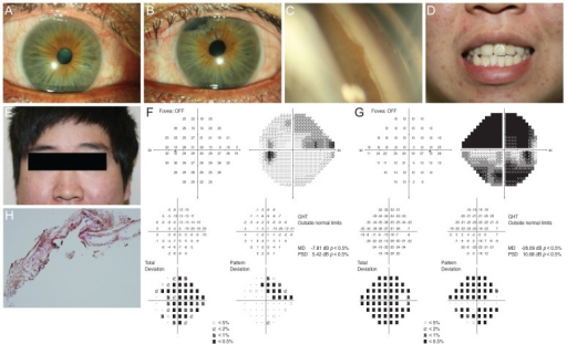 Axenfeld-Rieger syndrome spectrum: slit lamp photographs showing posterior embryotoxon and iris abnormalities, gonioscopy, dental anomalies, facial features, and visual field defects