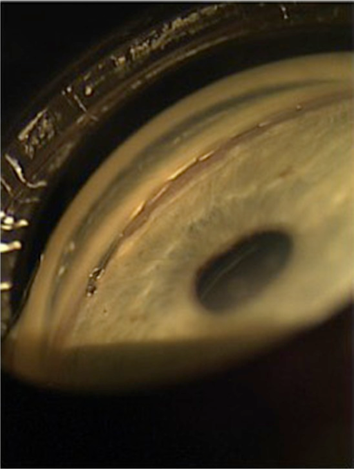 The Hydrus trabecular stent sitting within a dilated Schlemm's canal.Note: Reprinted from Grover DS, Godfrey DG, Smith O