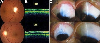 Individual III5 (top) right eye, (bottom) left eye. A: Fundus images showing typical glaucomatous cupping of the optic d