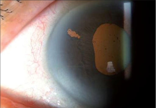 Slit lamp photograph showing a patent laser peripheral iridotomy hole in the iris after angle closure management