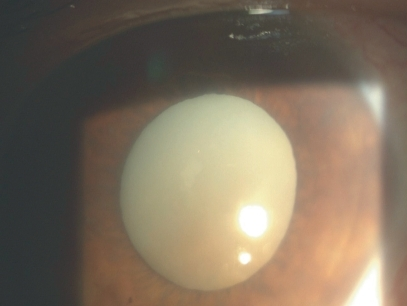 Clinical photograph of a hypermature cataractous lens causing lens-induced glaucoma