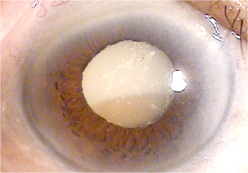 Slit-lamp photograph showing corneal edema, iridescent crystalline material in anterior chamber, and hypermature cataract in phacolytic glaucoma