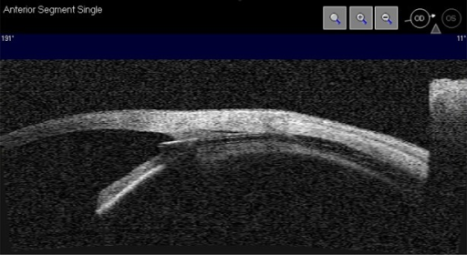 Anterior segment OCT image of an <b>iStent</b> Supra in situ with fluid in the suprachoroidal space