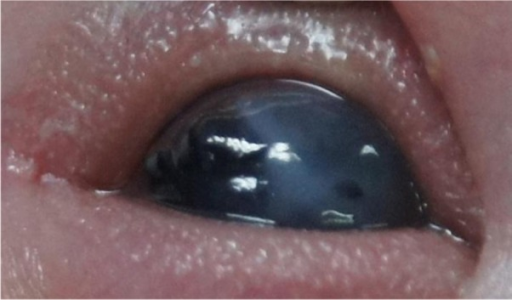 Initial anterior segment findings of the right eye. Central corneal opacity, corneal thinning, and iridocorneal adhesion