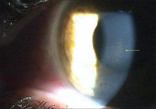 Slit-lamp photograph showing Krukenberg spindle - vertical spindle-shaped pigment deposit on corneal endothelium
