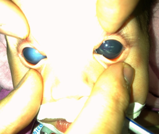 Bilateral buphthalmos in a baby with primary congenital glaucoma showing enlarged corneas