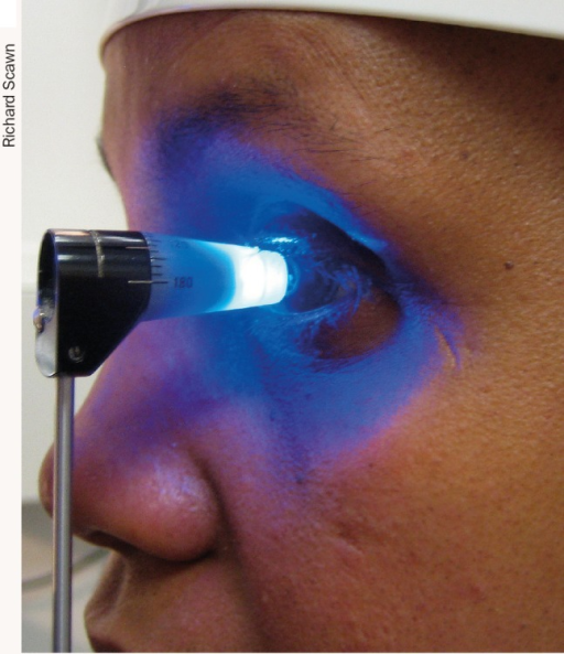 Goldmann applanation tonometry being performed on a patient's eye with cobalt blue illumination