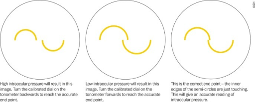 Goldmann applanation tonometry mires diagram showing high IOP, low IOP, and correct endpoint where inner edges of semicircles just touch
