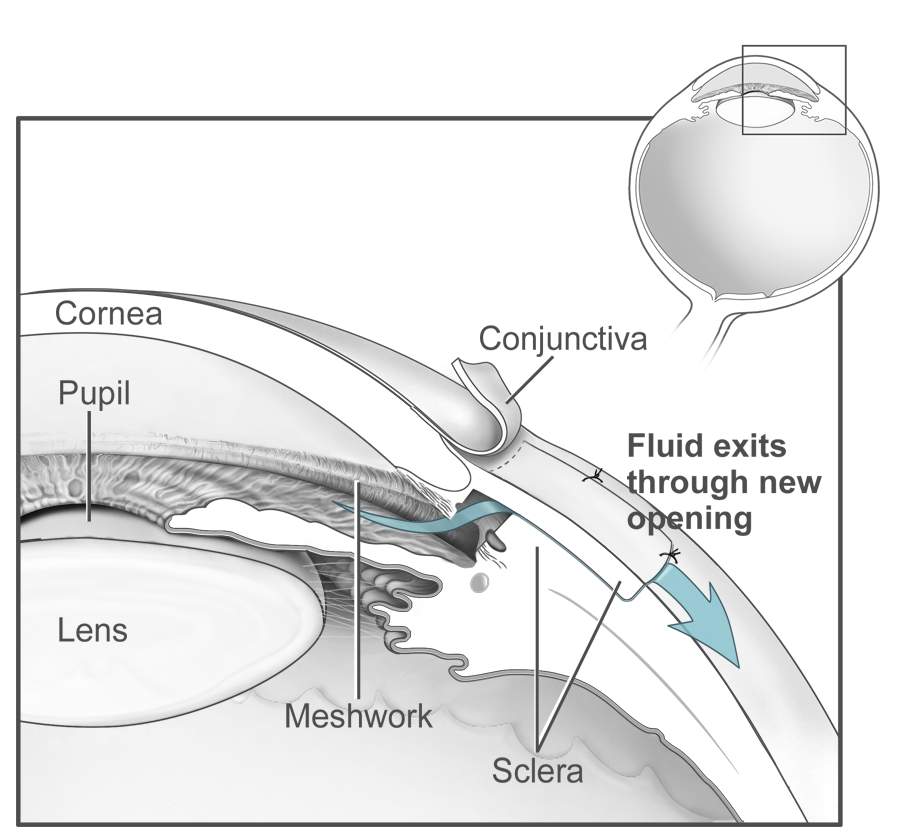 Post-trabeculectomy filtering bleb
