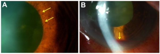 Slit lamp photographs showing hyphema with iris rubeosis and blood in anterior chamber