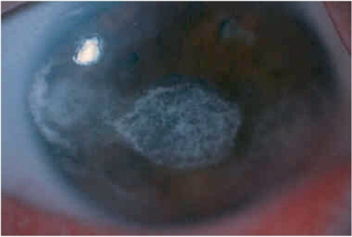 Severe band keratopathy in JIA-associated anterior uveitis
