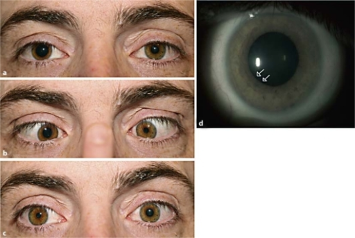 Anisocoria workup repeated 2 weeks after the initial diagnosis of an acute right Adie's <b>tonic pupil</b>. a <b>Pupils<