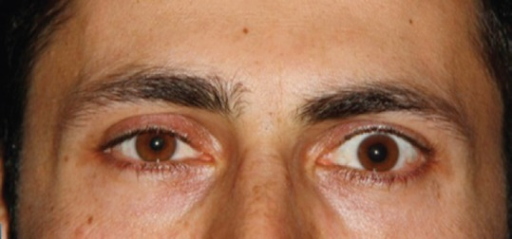 Right eye miosis, blepharoptosis and lower eyelid margin inverse ptosis.