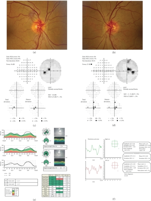 Acute LHON fundus photos showing bilateral optic disc pseudoedema with peripapillary telangiectatic microangiopathy, visual fields, OCT RNFL thickness, and VEP findings.