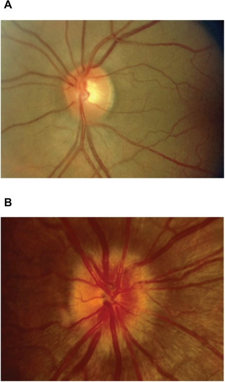 Fundus photographs showing (A) normal optic disc and (B) optic disc swelling (papillitis) in optic neuritis with hyperemia and blurred disc margins.
