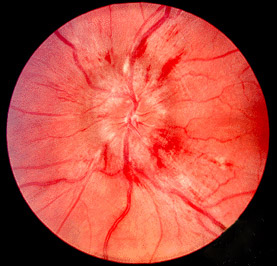 Papilledema fundus photograph