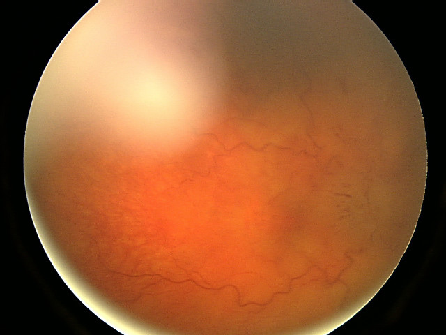 Severe papilledema with hemorrhages