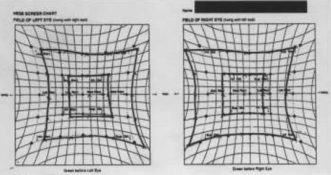 Hess screen test: paresis of the left lateral rectus with overreaction of the right medial rectus indicates the ocular m