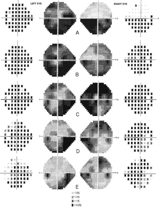 Evolution of visual field testing (24-2) over the course of docetaxel <b>toxic optic neuropathy</b> (Total Deviation and