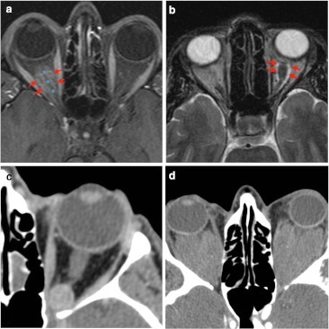 Examples of <b>intra-conal</b> mass-like lesions are given. a Fat-suppressed T1-weighted imaging shows tubular mass lesi